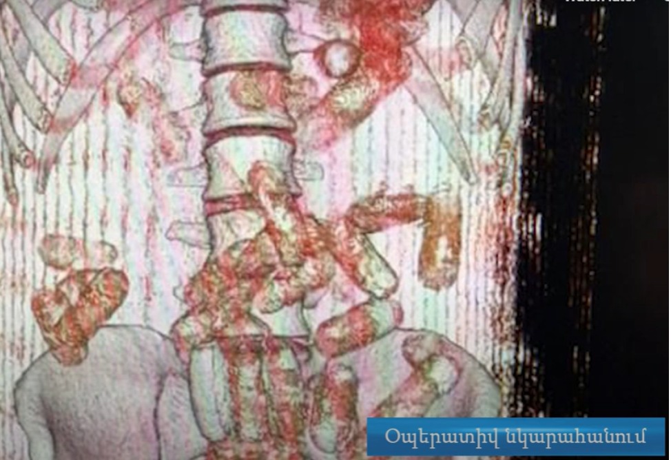 В Армении задержан гражданин Нидерландов, перевозивший в желудке 50 капсул с 845 граммами кокаина 